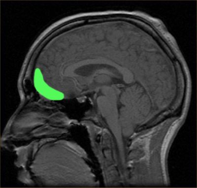 Approximate location of the OFC shown on a sagittal MRI. Image courtesy Wikimedia Commons.