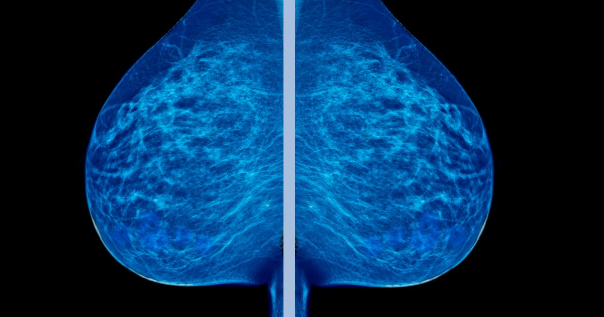 Half of all women experience false positive mammograms after 10